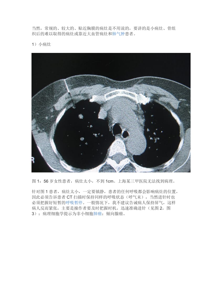 CT引导下经皮肺穿刺的几点心得名师制作优质教学资料.doc_第2页