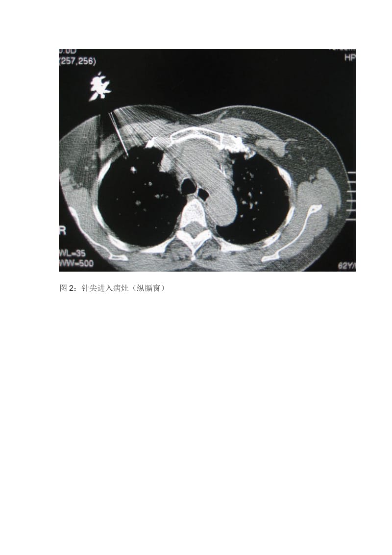 CT引导下经皮肺穿刺的几点心得名师制作优质教学资料.doc_第3页
