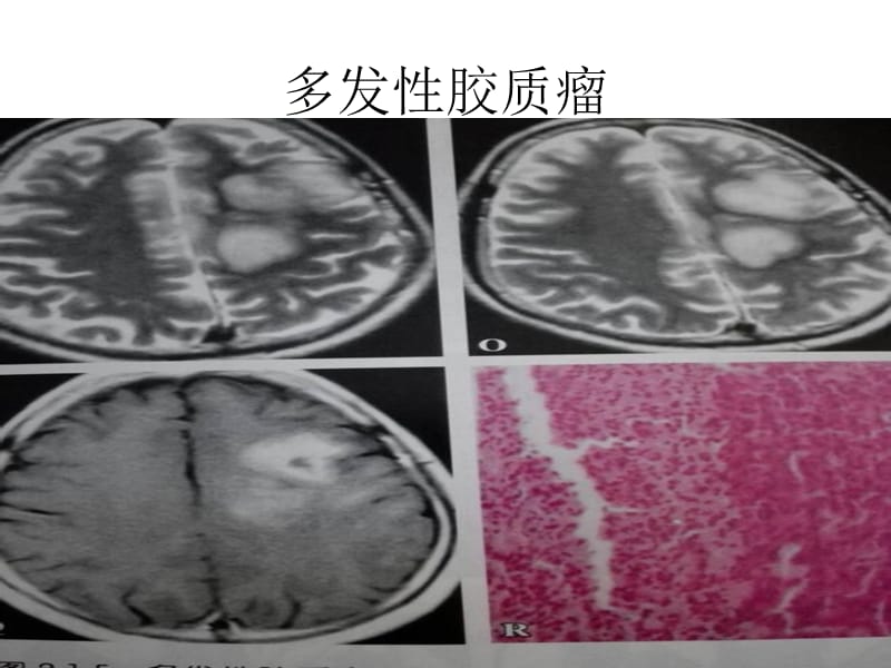 医学课件神经系统疾病图片.ppt_第1页