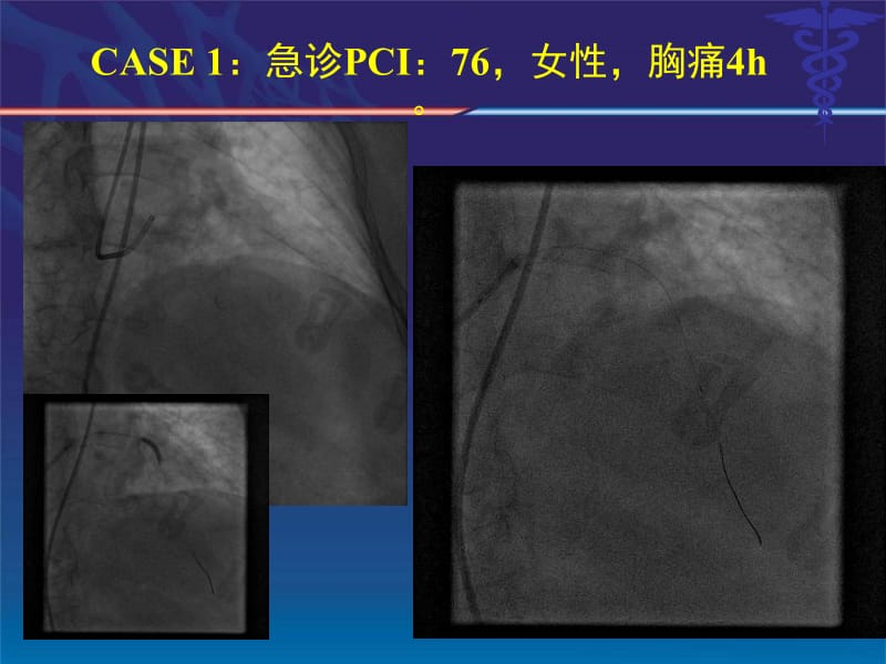 医学课件直接PCI术中无复流慢血流的应对策略.ppt_第2页