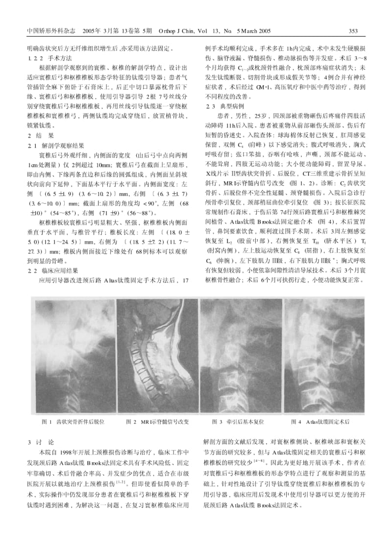 Atlas钛缆固定上颈椎的解剖与临床.pdf_第2页