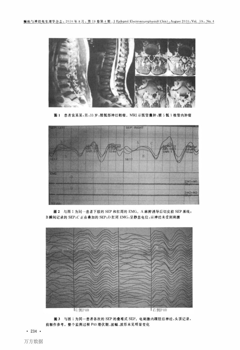 SEP、EMG监测在腰骶部椎管内病变术中的应用.pdf_第3页