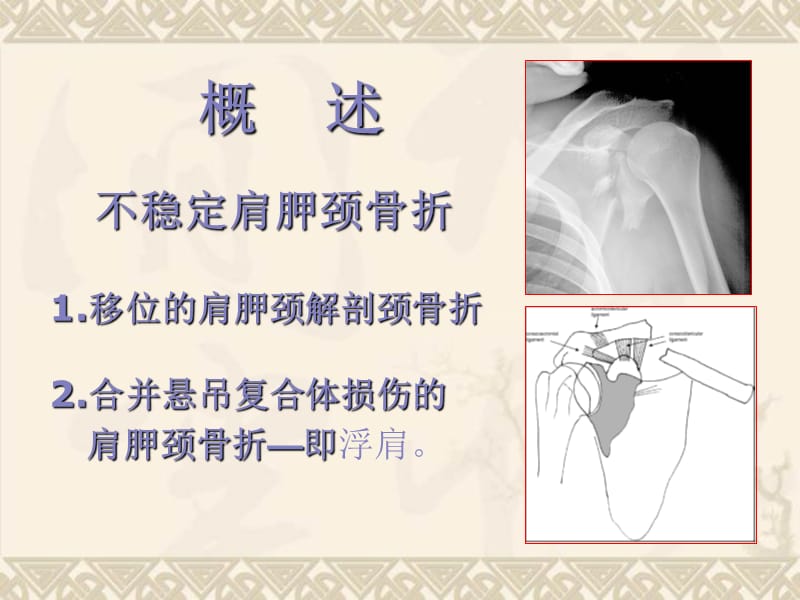 不稳定肩胛颈骨折的手术治疗.ppt_第1页