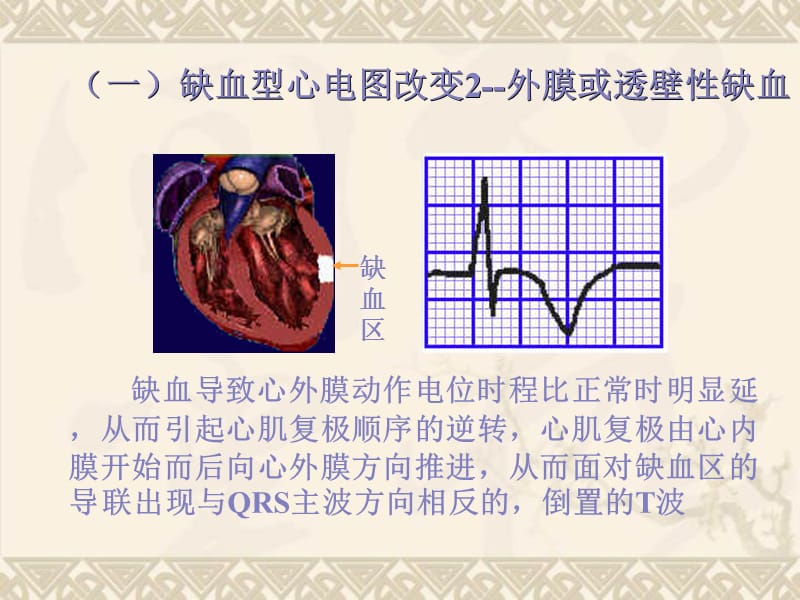 5心肌缺血、心肌梗死.ppt_第3页