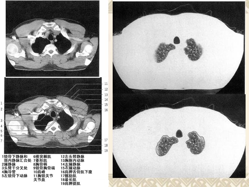 CT胸部正常解剖.ppt_第1页