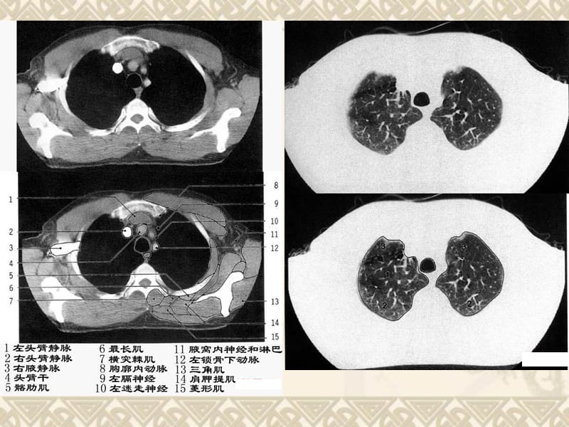 CT胸部正常解剖.ppt_第3页