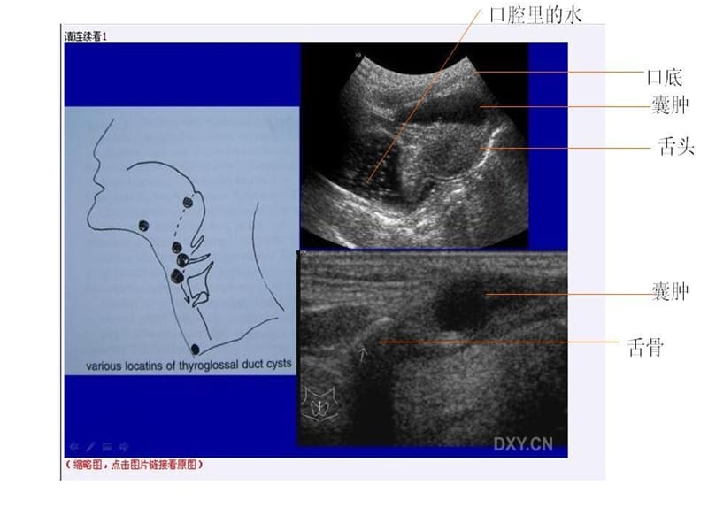 【讲座】颈部常见肿物的超声诊断.ppt_第2页