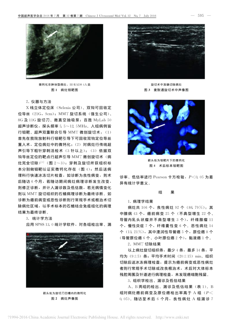 微创旋切术在乳腺BI-RADS4A类微钙化非肿块型病灶诊治中的应用.pdf_第2页