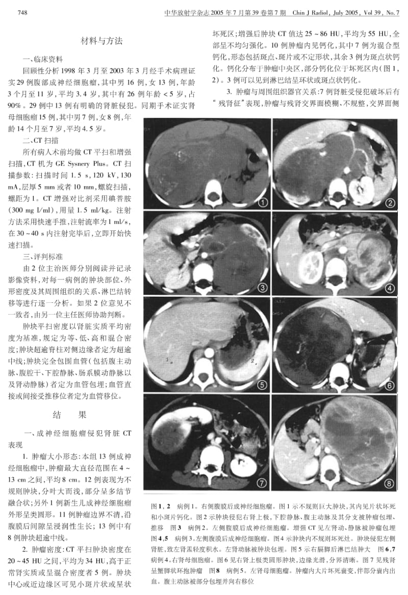 儿童腹膜后成神经细胞瘤侵犯肾脏与肾母细胞瘤的鉴别诊断.pdf_第2页