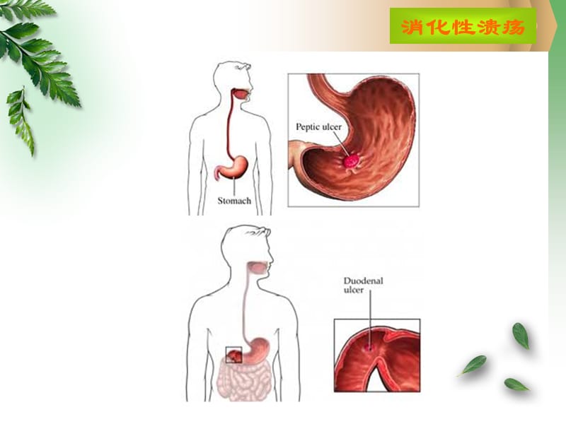 病例-消化性溃疡名师编辑PPT课件.ppt_第3页