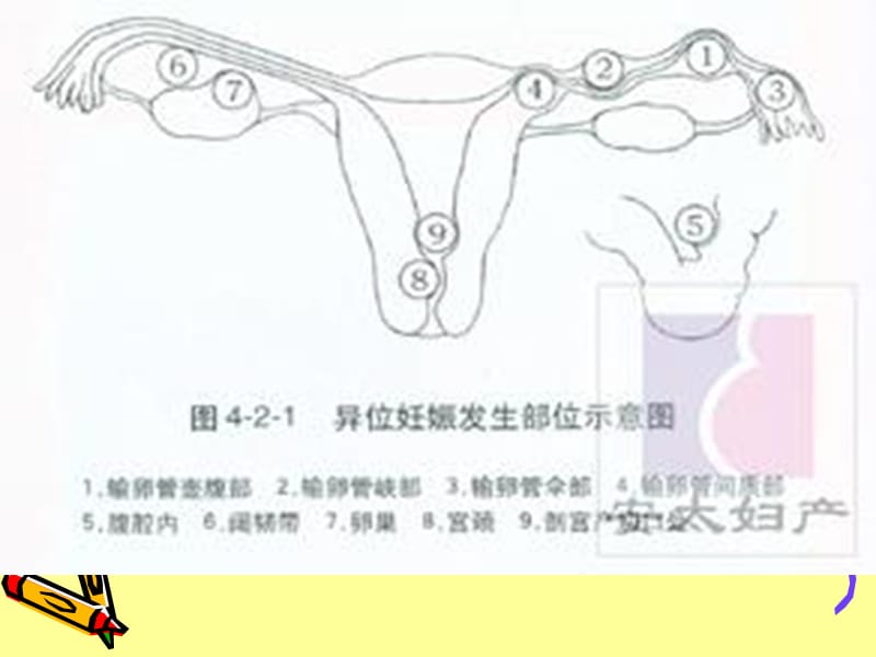 异位妊娠健教名师编辑PPT课件.ppt_第3页