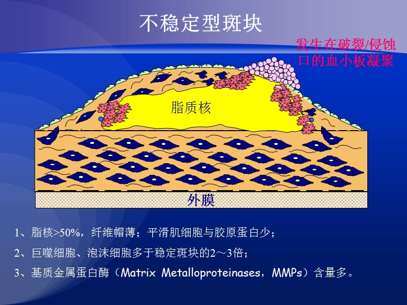 冠心病review名师编辑PPT课件.ppt_第3页