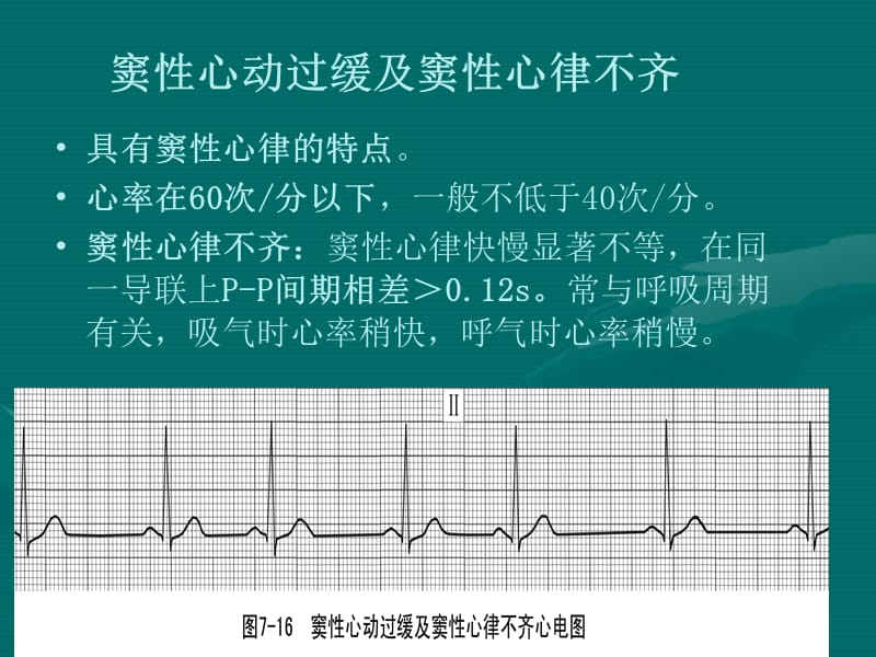 常见心律失常.ppt_第3页