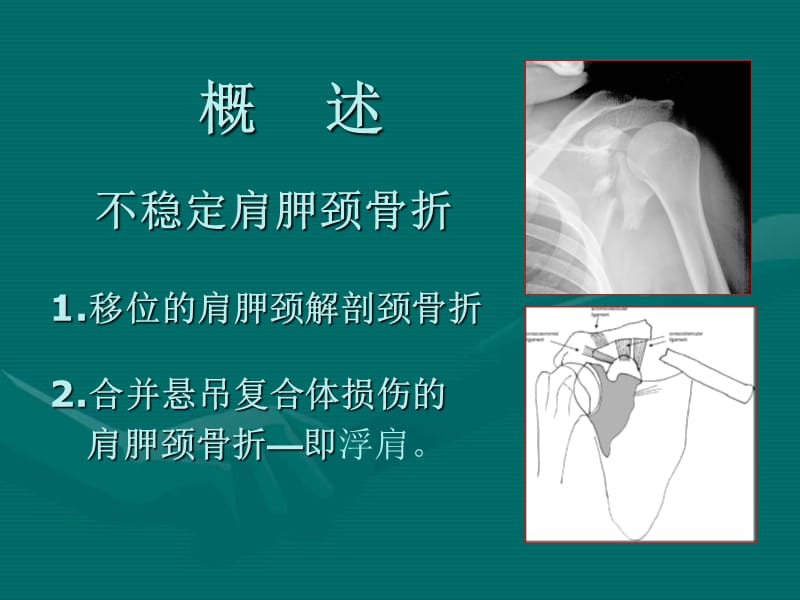 不稳定肩胛颈骨折的手术治疗.ppt_第1页