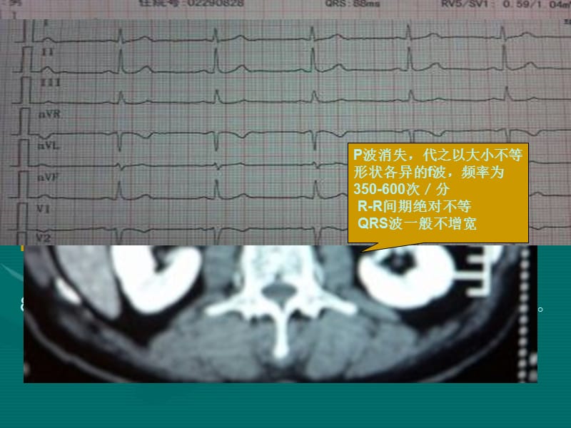 胆总管结石护理.ppt_第3页