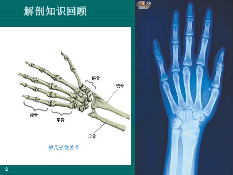 多指畸形.ppt_第2页