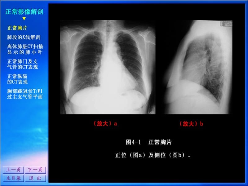 0207影像诊断学系列图谱-呼吸系统.ppt_第2页