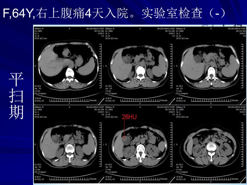 胆囊腺肌增生症.ppt_第2页