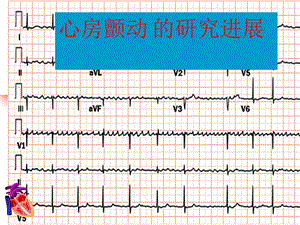 房颤的研究进展.ppt