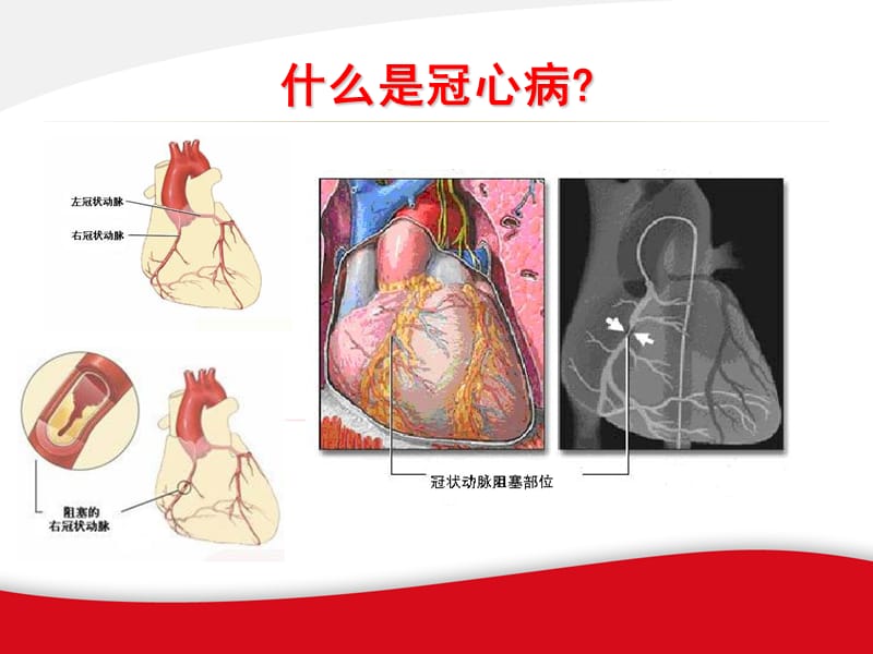 冬季冠心病防治患者教育.ppt_第2页