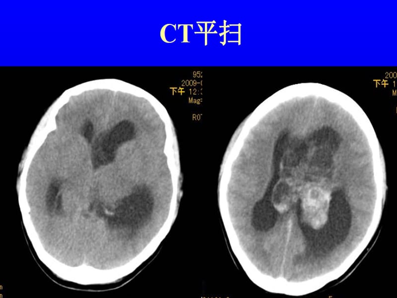 2018年侧脑室中枢神经细胞瘤ppt课件-文档资料.ppt_第2页