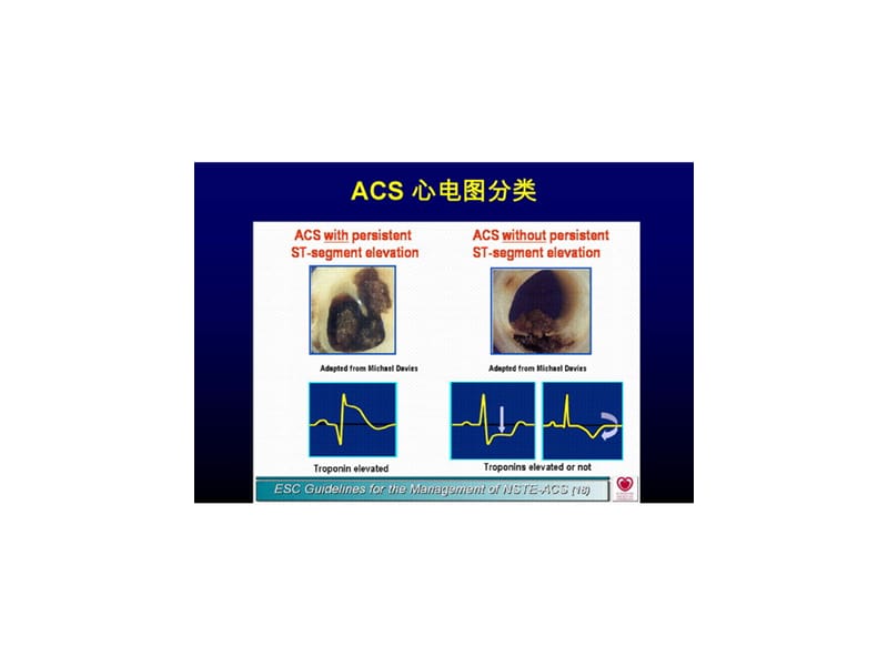 2018年心肌缺血心电图改变及鉴别-文档资料.ppt_第1页