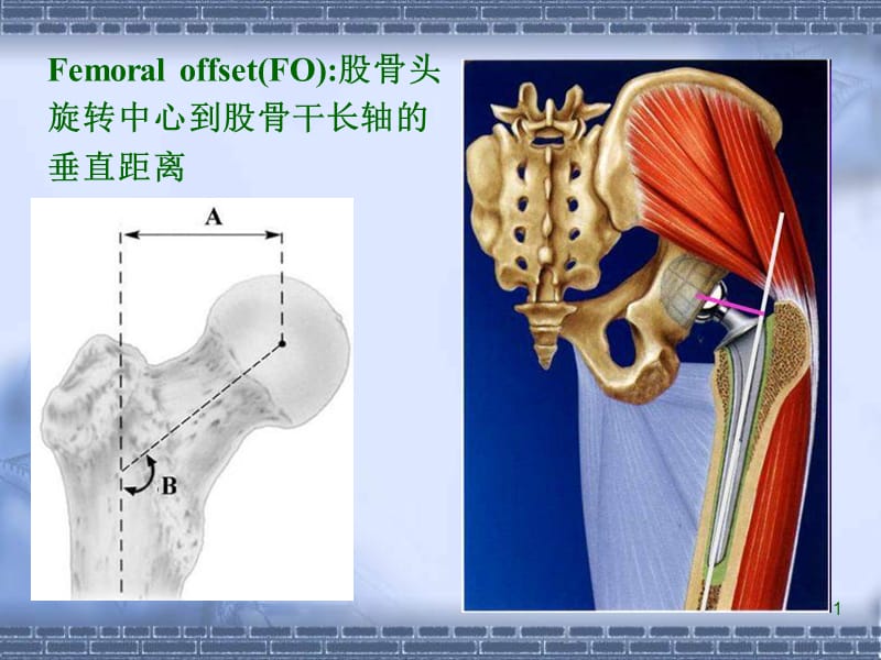 最新：[PPT]-正常髋关节股骨偏心距的影像学研究-文档资料.ppt_第1页