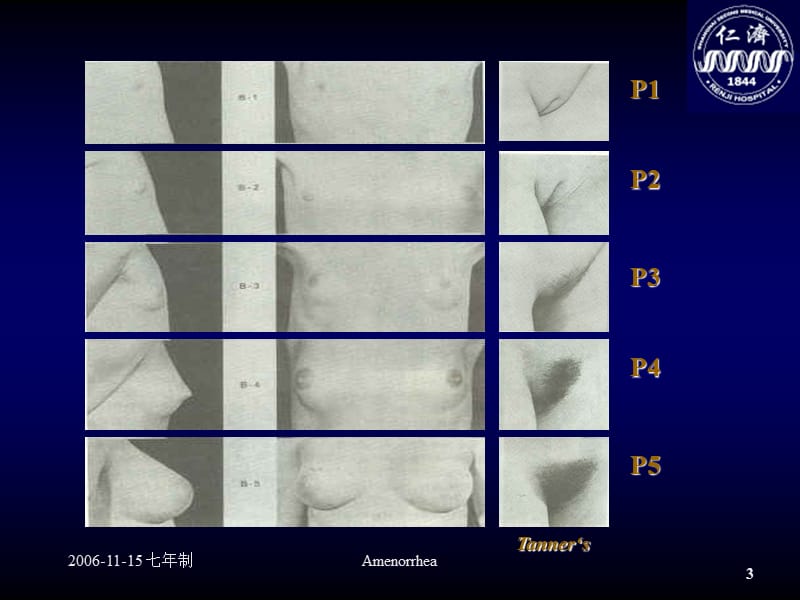 最新Amenorhea妇产科仁济临床医院-PPT文档.ppt_第3页