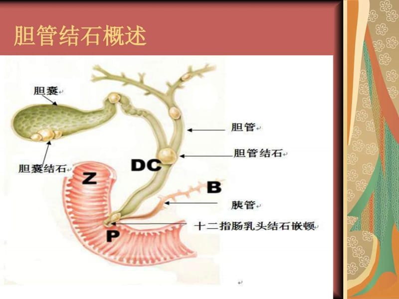 最新ERCP治疗胆总管结石的护理-PPT文档.ppt_第3页