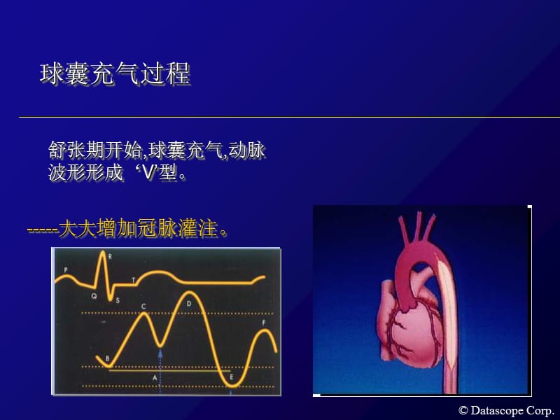 2018年主动脉内球囊反搏泵的临床使用-文档资料.ppt_第2页