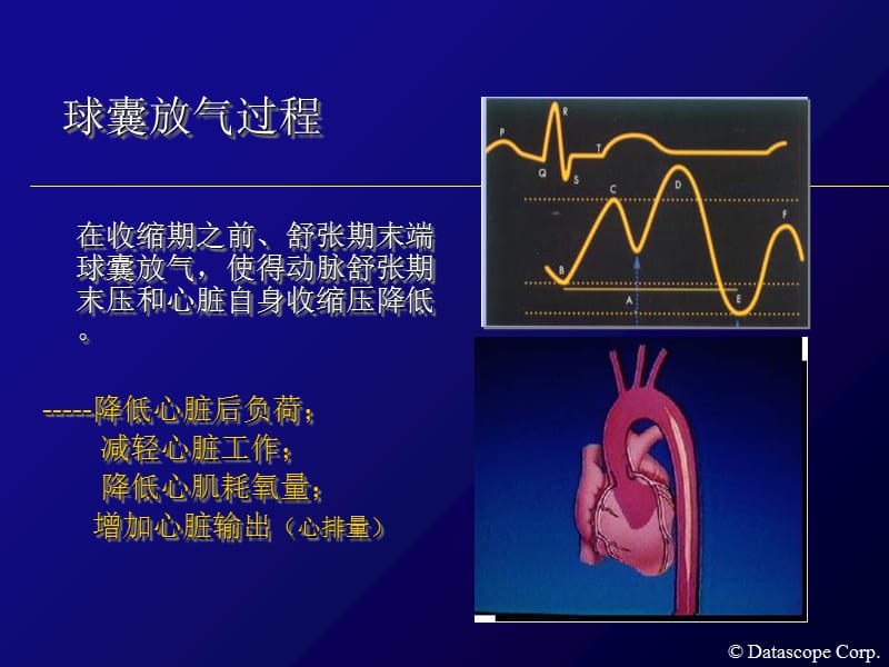 2018年主动脉内球囊反搏泵的临床使用-文档资料.ppt_第3页