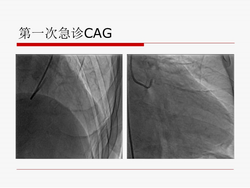 pci术中的冠状动脉痉挛病例_胡奉环-PPT文档.ppt_第2页