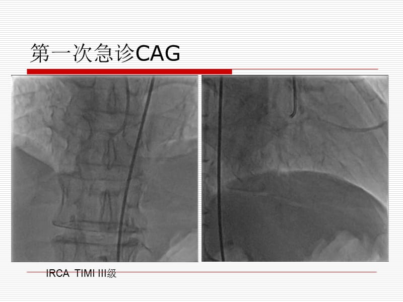 pci术中的冠状动脉痉挛病例_胡奉环-PPT文档.ppt_第3页