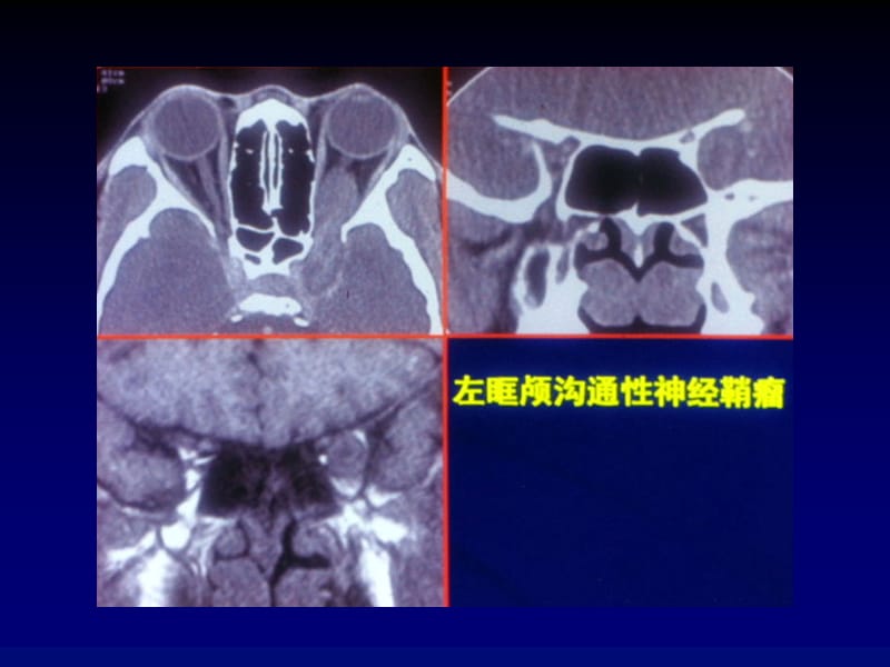 2018年眼眶肿瘤的CT MRI诊断-天津医科大学总医院_课件-文档资料.ppt_第3页