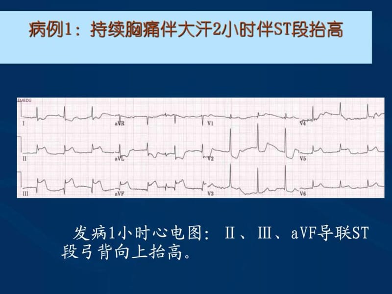 2018年急性心肌梗死的紧急救治-文档资料.ppt_第3页