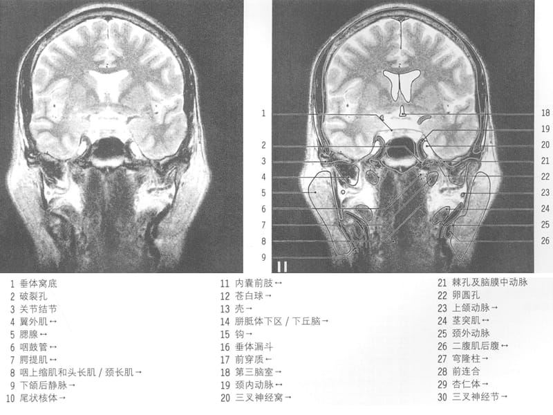 最新：MRI颅脑冠状位解剖图谱(2)-文档资料.ppt_第1页