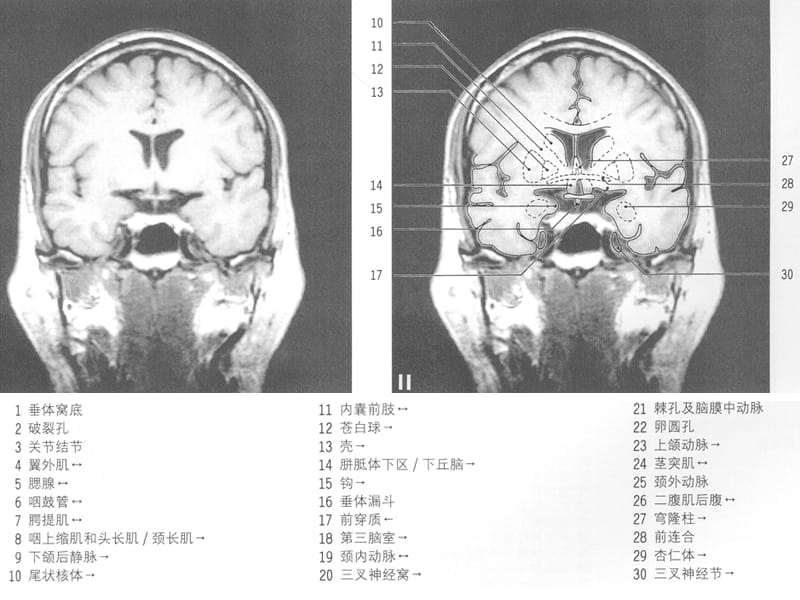 最新：MRI颅脑冠状位解剖图谱(2)-文档资料.ppt_第2页