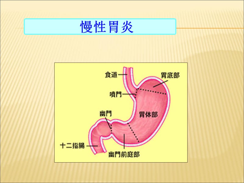 2018年慢性胃炎护理查房-文档资料.ppt_第3页