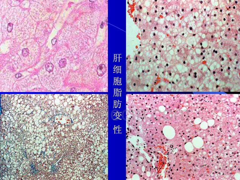 2018年医学PPT课件脂肪肝与动脉粥样硬化-文档资料.ppt_第3页