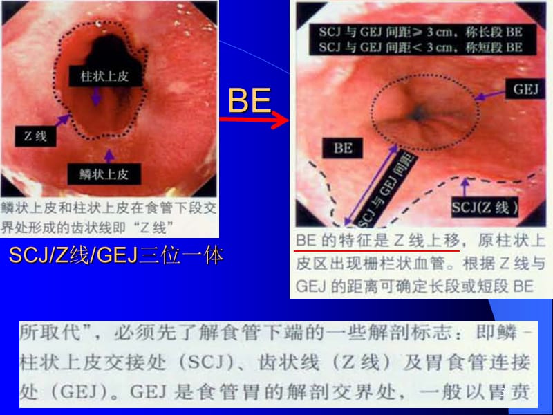 Barrett食管最新机制治疗课件-文档资料.ppt_第3页