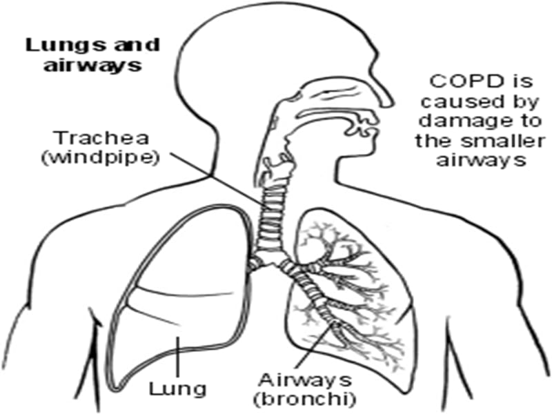 最新：COPD、慢性支气管炎-文档资料.ppt_第3页