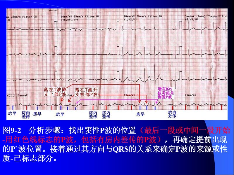 2018年P波的识别与相关病例讨论之二-文档资料.ppt_第2页