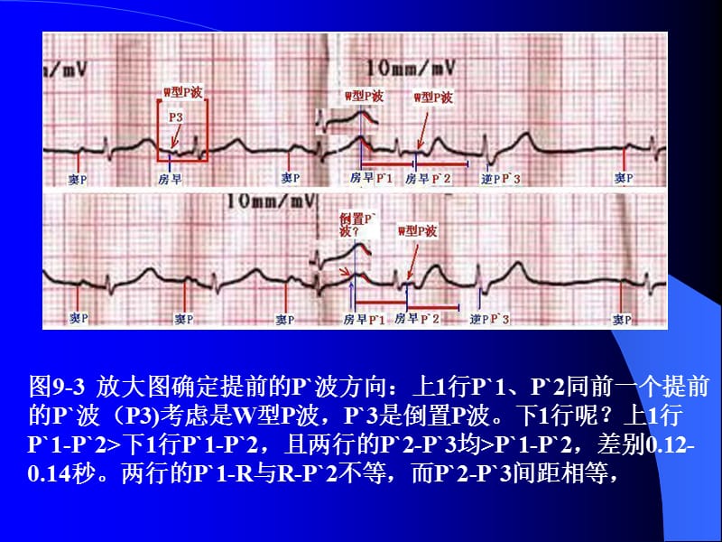 2018年P波的识别与相关病例讨论之二-文档资料.ppt_第3页