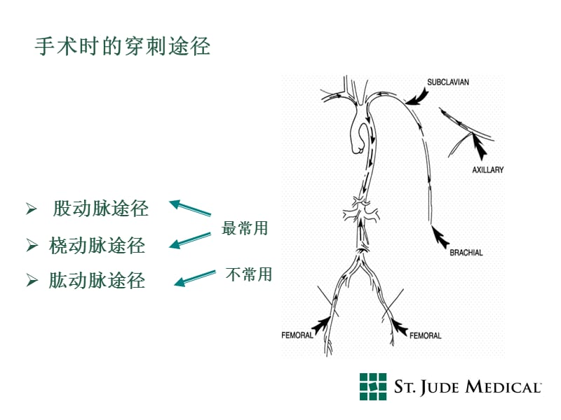 最新Angio-Seal血管封合器PPT课件-PPT文档.pptx_第2页