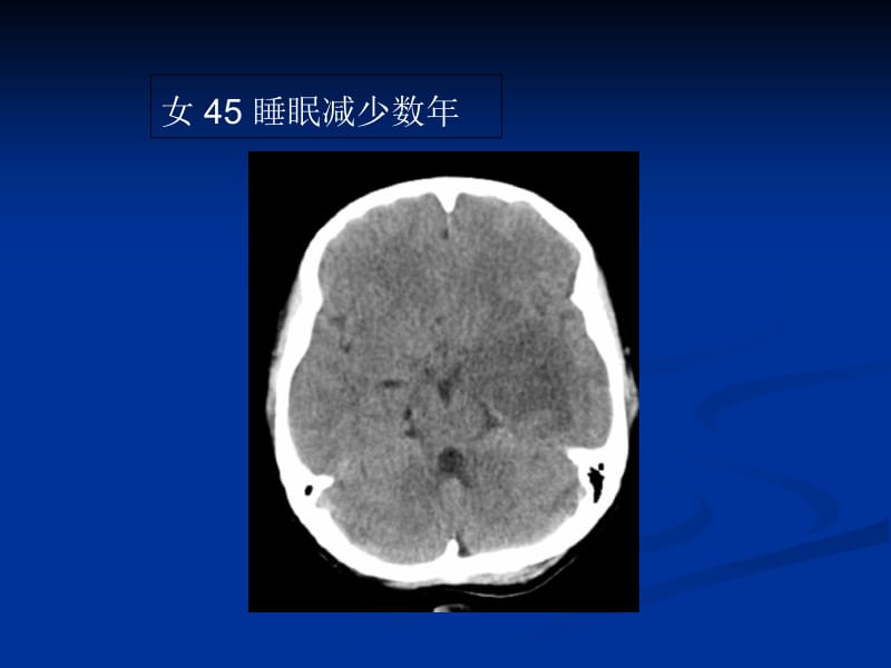 2018年影像学-02中枢神经系统-文档资料.ppt_第3页