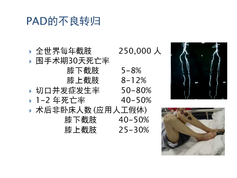 2018年下肢动脉硬化的药物治疗新选择---安步乐克-文档资料.ppt_第3页