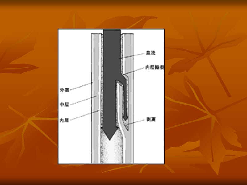 2018年主动脉夹层-文档资料.ppt_第2页