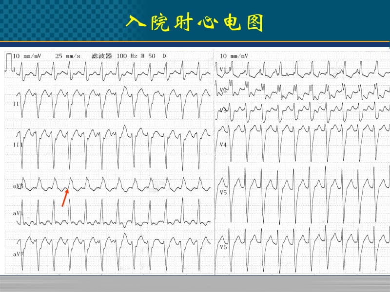 《心律失常病例》-精选文档.pptx_第2页