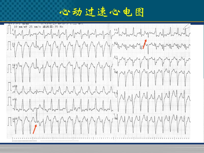 《心律失常病例》-精选文档.pptx_第3页