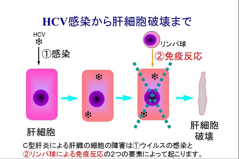 最新C型肝分析课件-PPT文档.ppt_第2页